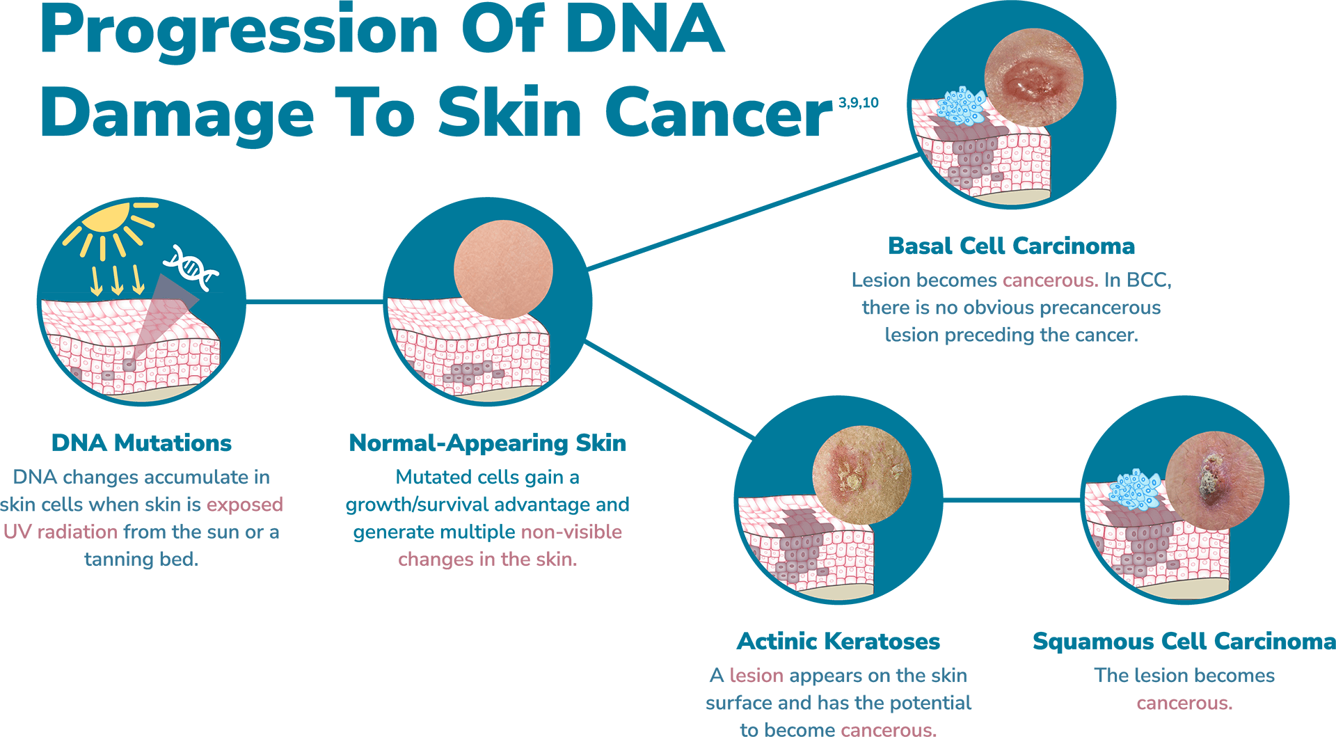 Progression: DNA Damage to Skin Cancer